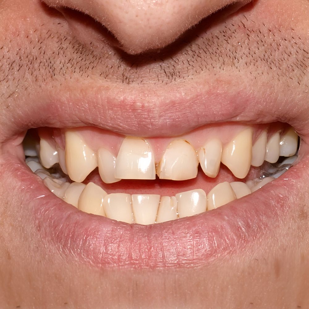 Misshapen Teeth