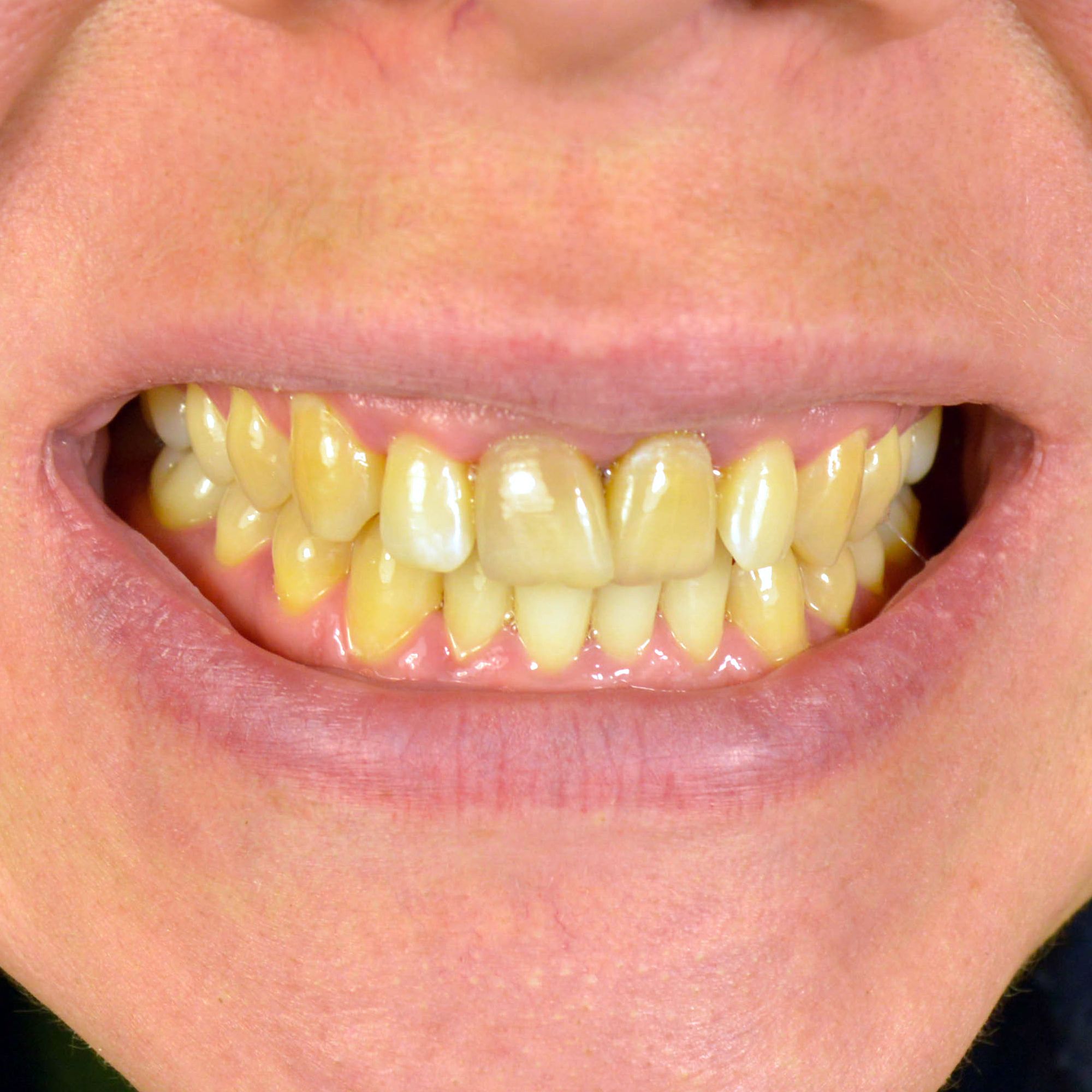 stained teeth